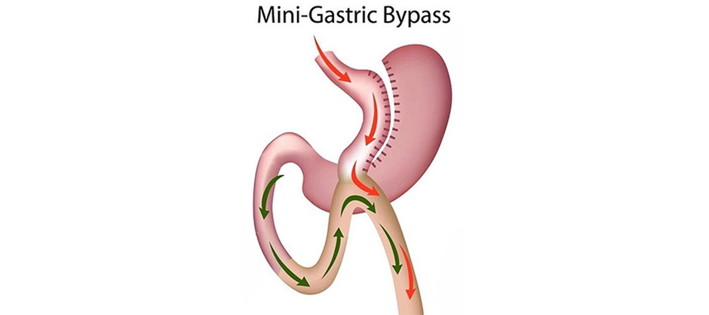Mini Gastric Bypass Safe Health Doctors